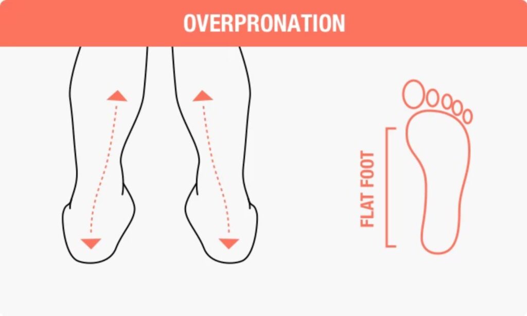 Overpronation